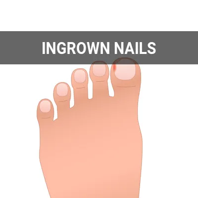 Visit our Ingrown Nails page